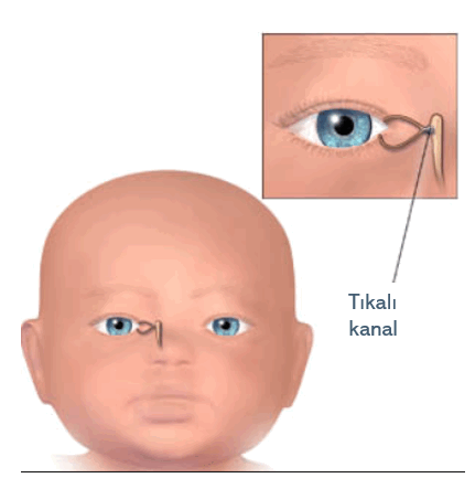 göz yaşı kanalı olan çocuğun tıkalı olan kanalının demonstratif anatomisi