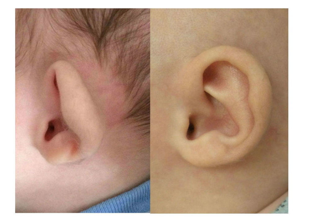 bebek kulak şekil bozkluğu