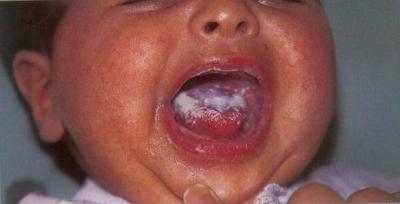 ağzı açık olan bebğin dilindeki pamukçuk moniliazis görülüyor