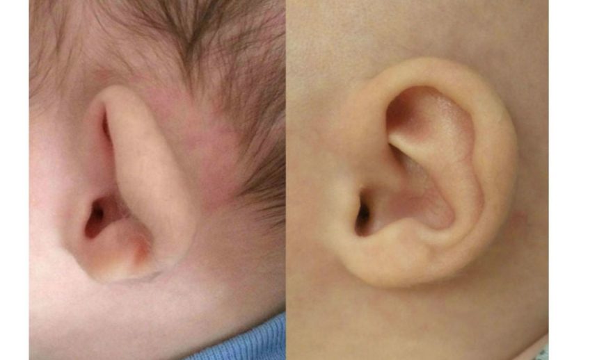 bebek kulak şekil bozkluğu